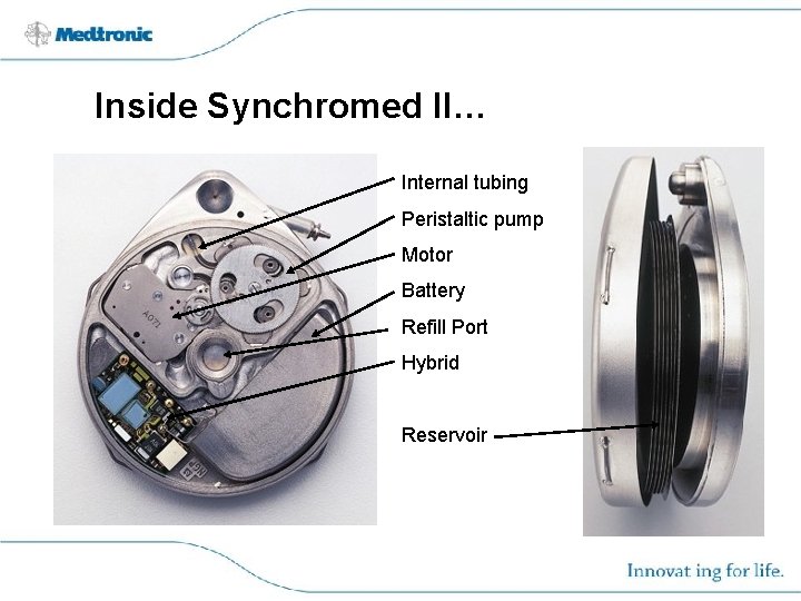 Inside Synchromed II… Internal tubing Peristaltic pump Motor Battery Refill Port Hybrid Reservoir 