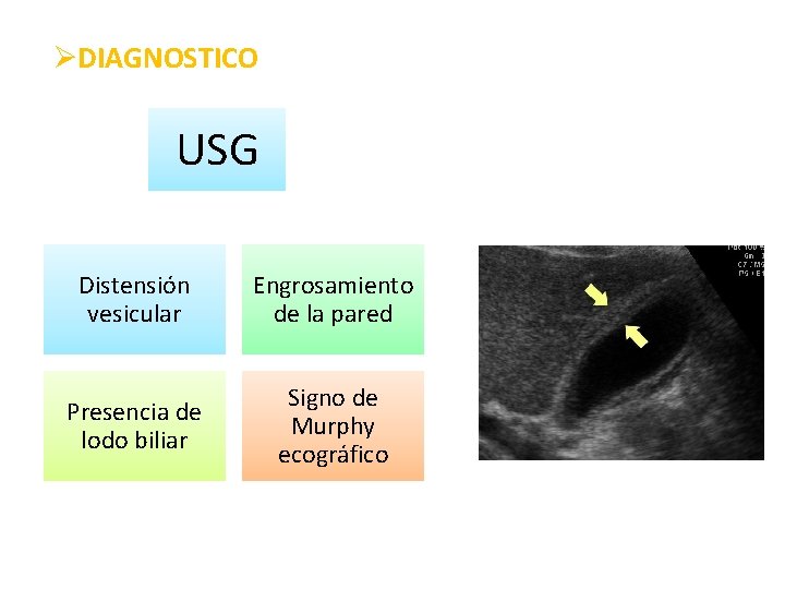 ØDIAGNOSTICO USG Distensión vesicular Engrosamiento de la pared Presencia de lodo biliar Signo de