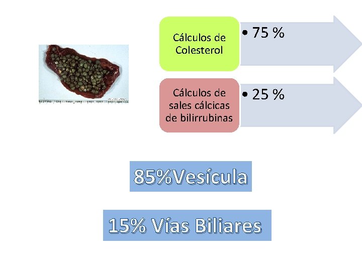 Cálculos de Colesterol Cálculos de sales cálcicas de bilirrubinas • 75 % • 25