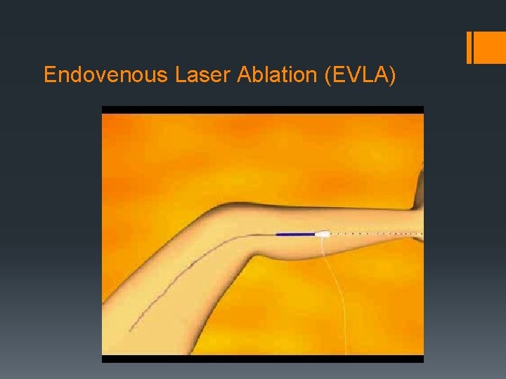 Endovenous Laser Ablation (EVLA) 