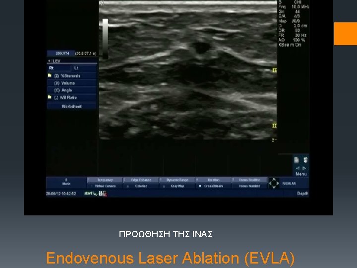 ΠΡΟΩΘΗΣΗ ΤΗΣ ΙΝΑΣ Endovenous Laser Ablation (EVLA) 