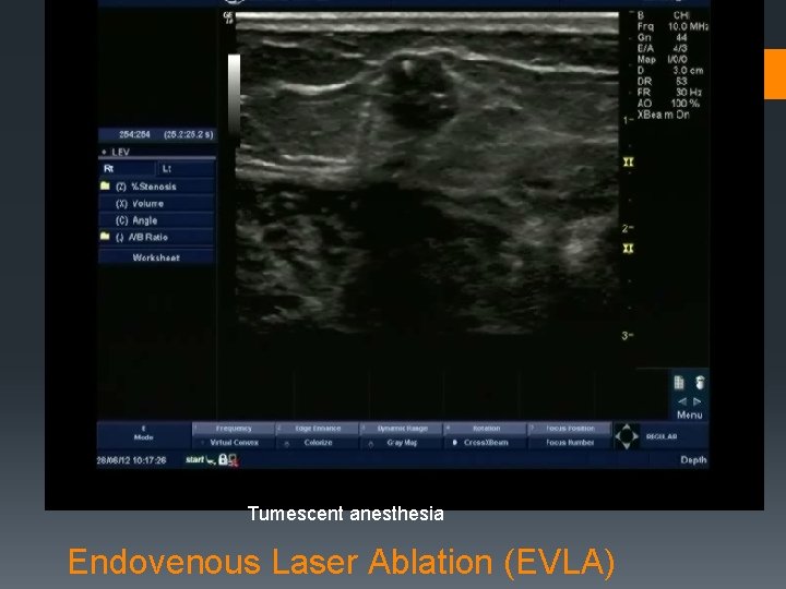 Tumescent anesthesia Endovenous Laser Ablation (EVLA) 