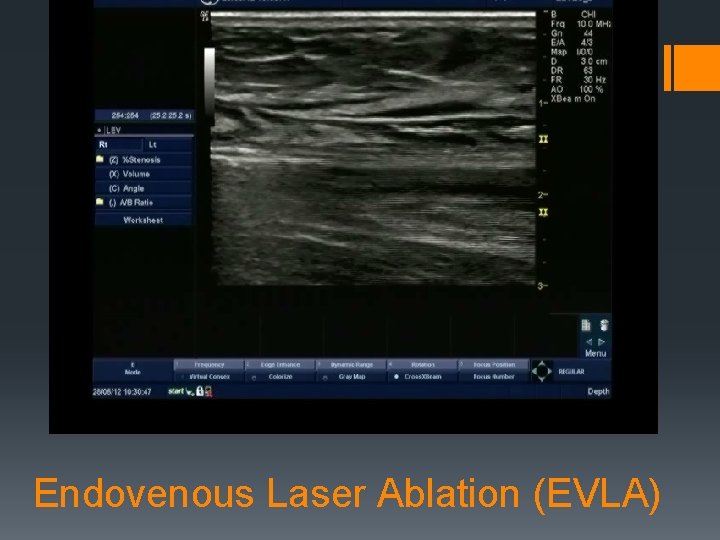 Endovenous Laser Ablation (EVLA) 