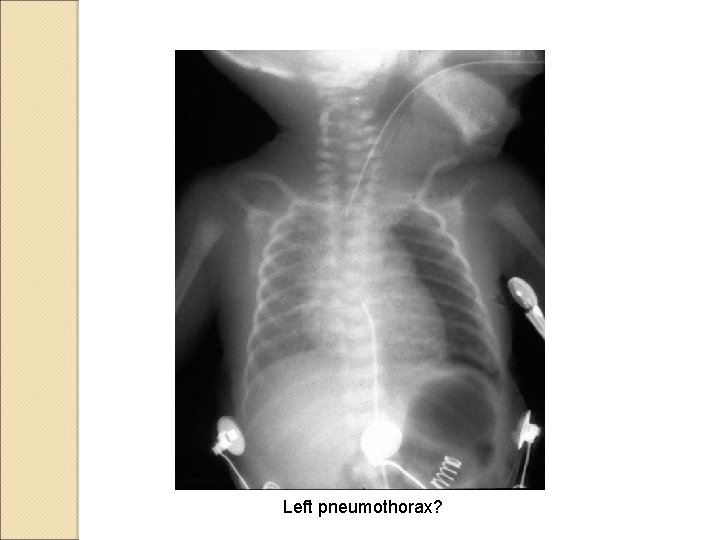 Left pneumothorax? Left pneumothorax?