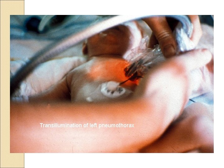 Transillumination of left pneumothorax 