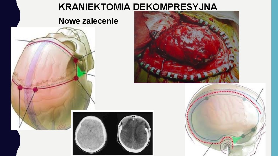 KRANIEKTOMIA DEKOMPRESYJNA Nowe zalecenie 