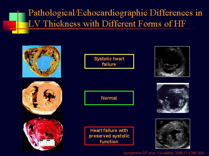 Pathological/Echocardiographic Differences in LV Thickness with Different Forms of HF Systolic heart failure Normal