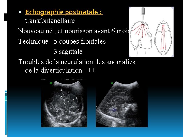  Echographie postnatale : transfontanellaire: Nouveau né , et nourisson avant 6 mois Technique