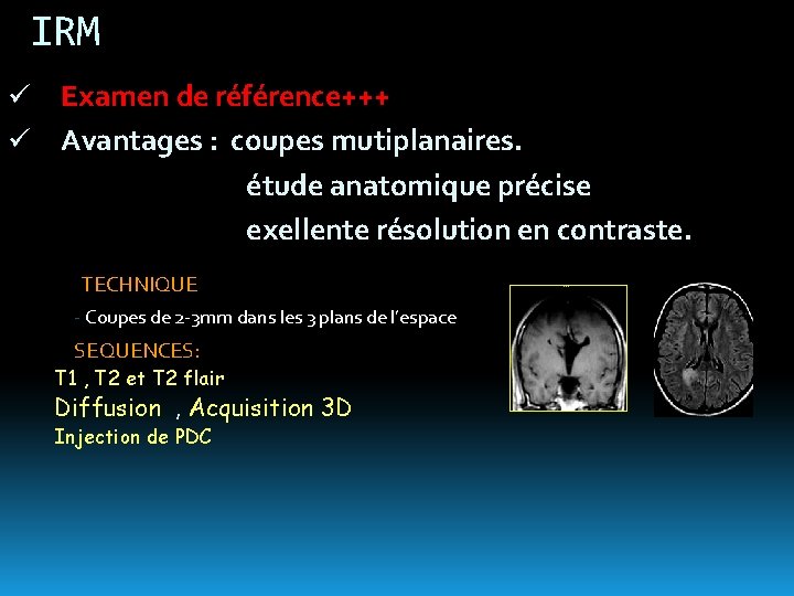 IRM ü Examen de référence+++ ü Avantages : coupes mutiplanaires. étude anatomique précise exellente