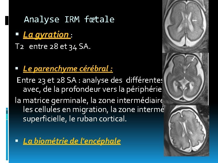 Analyse IRM fœtale La gyration : T 2 entre 28 et 34 SA. Le