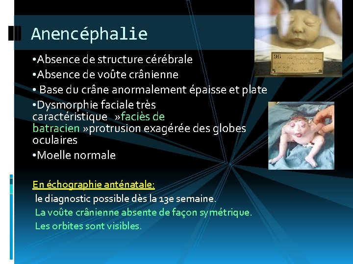 Anencéphalie • Absence de structure cérébrale • Absence de voûte crânienne • Base du