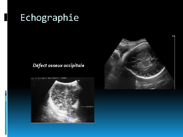 Echographie Défect osseux occipitale 