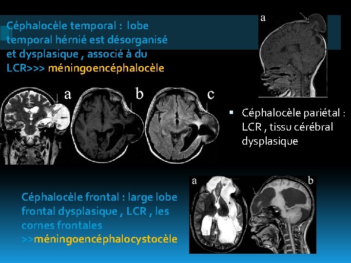 Céphalocèle temporal : lobe temporal hérnié est désorganisé et dysplasique , associé à du