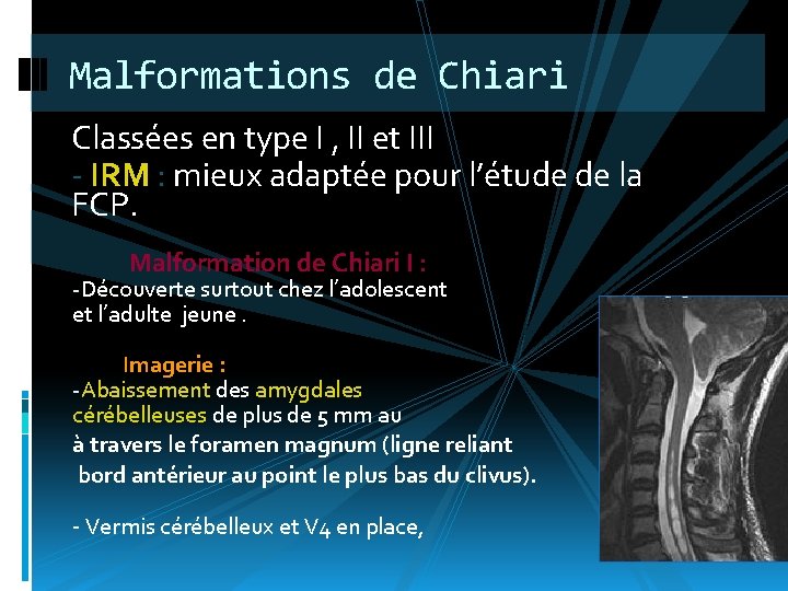 Malformations de Chiari Classées en type I , II et III - IRM :