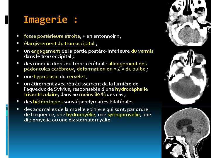 Imagerie : fosse postérieure étroite, « en entonnoir » , élargissement du trou occipital