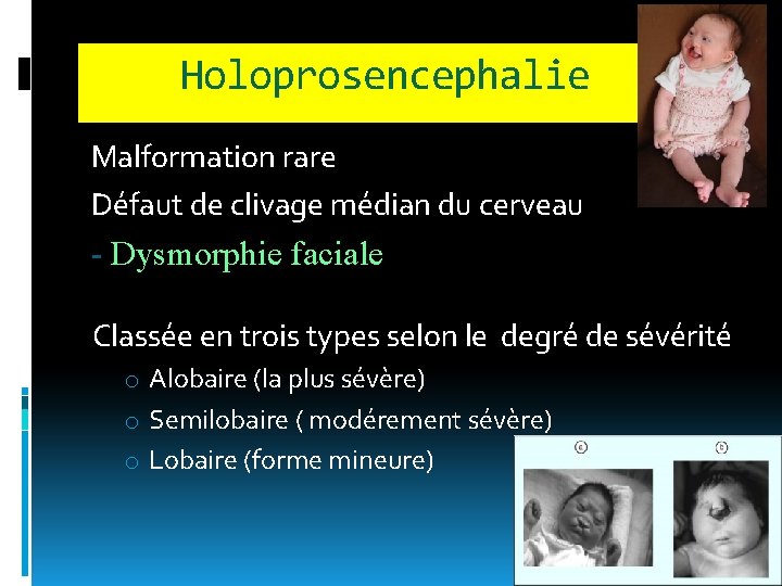 Holoprosencephalie Malformation rare Défaut de clivage médian du cerveau - Dysmorphie faciale Classée en