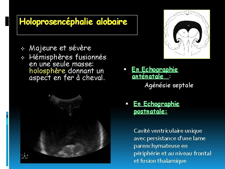 Holoprosencéphalie alobaire v v Majeure et sévère Hémisphères fusionnés en une seule masse: holosphère