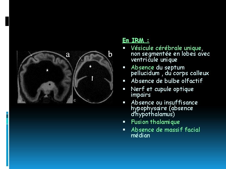 En IRM : Vésicule cérébrale unique, non segmentée en lobes avec ventricule unique Absence