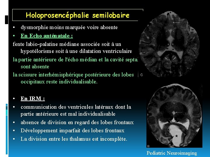 Holoprosencéphalie semilobaire • dysmorphie moins marquée voire absente • En Echo anténatale : fente