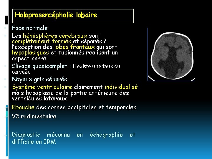 Holoprosencéphalie lobaire Face normale Les hémisphères cérébraux sont complètement formés et séparés à l’exception