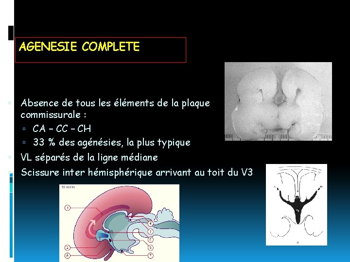 AGENESIE COMPLETE Absence de tous les éléments de la plaque commissurale : CA –