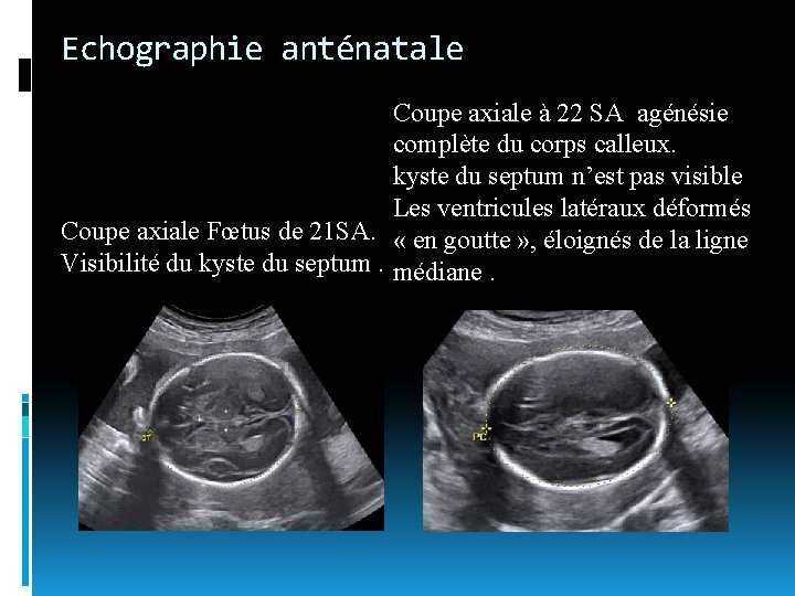 Echographie anténatale Coupe axiale à 22 SA agénésie complète du corps calleux. kyste du