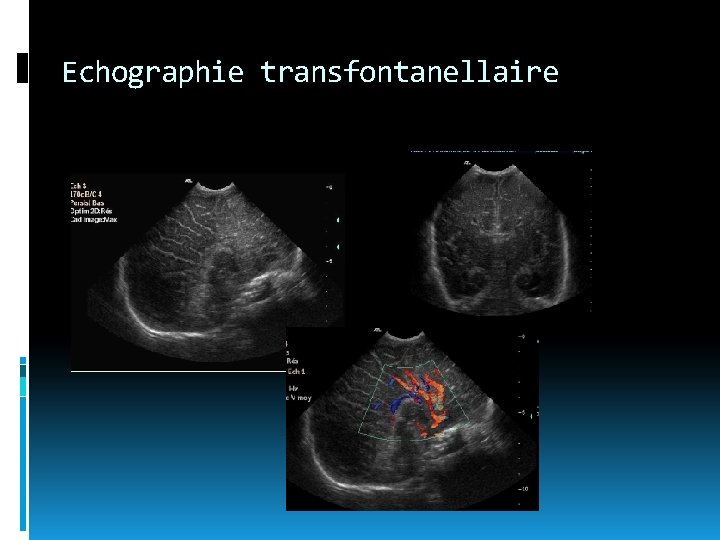 Echographie transfontanellaire 