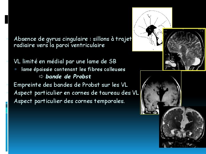  Absence de gyrus cingulaire : sillons à trajet radiaire vers la paroi ventriculaire
