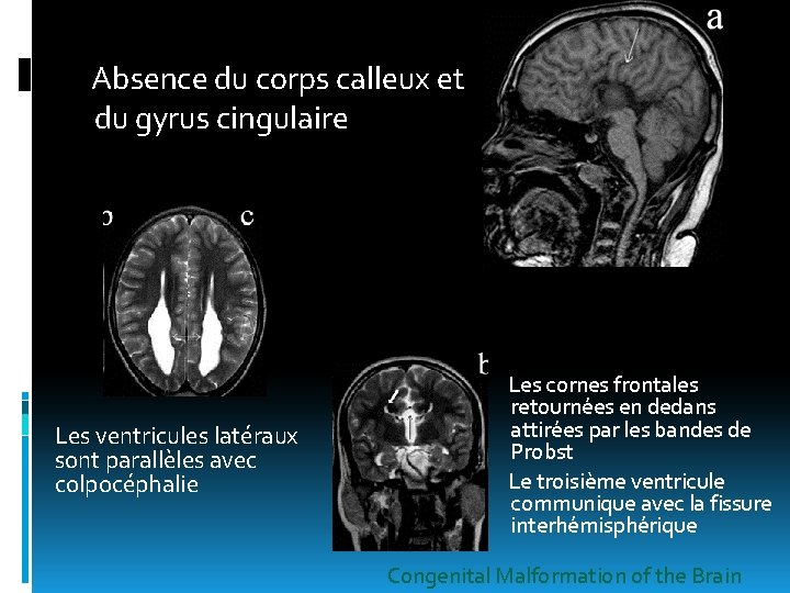 Absence du corps calleux et du gyrus cingulaire Les ventricules latéraux sont parallèles avec