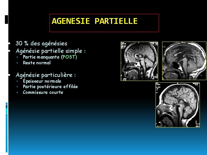 AGENESIE PARTIELLE 30 % des agénésies Agénésie partielle simple : Partie manquante (POST) Reste