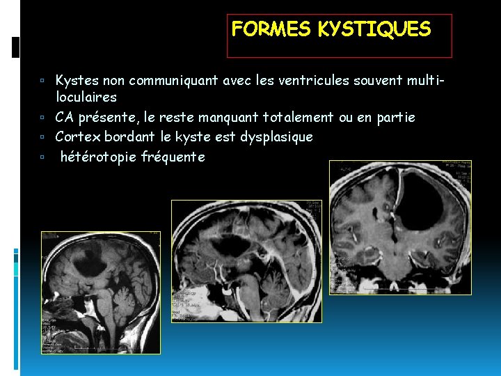 FORMES KYSTIQUES Kystes non communiquant avec les ventricules souvent multi- loculaires CA présente, le