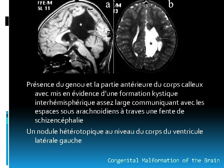 Présence du genou et la partie antérieure du corps calleux avec mis en évidence