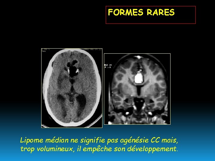 FORMES RARES Lipome médian ne signifie pas agénésie CC mais, trop volumineux, il empêche