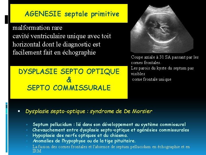 AGENESIE septale primitive malformation rare cavité ventriculaire unique avec toit horizontal dont le diagnostic