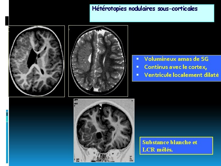 Hétérotopies nodulaires sous-corticales Volumineux amas de SG Continus avec le cortex, Ventricule localement dilaté