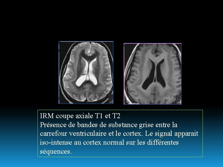 IRM coupe axiale T 1 et T 2 Présence de bandes de substance grise