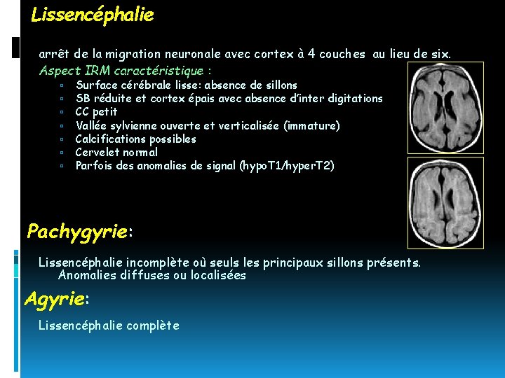 Lissencéphalie arrêt de la migration neuronale avec cortex à 4 couches au lieu de