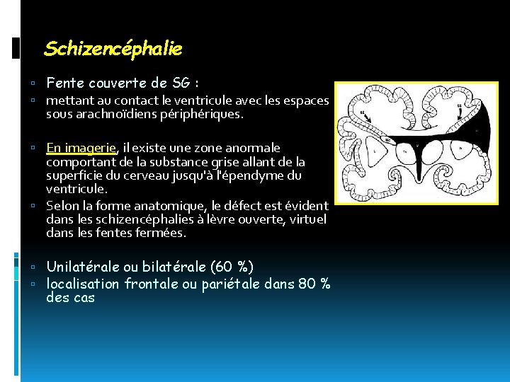 Schizencéphalie Fente couverte de SG : mettant au contact le ventricule avec les espaces