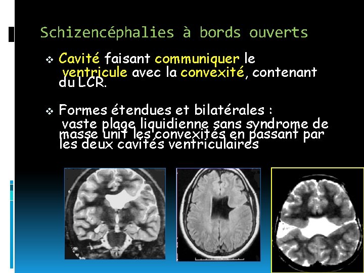 Schizencéphalies à bords ouverts v v Cavité faisant communiquer le ventricule avec la convexité,
