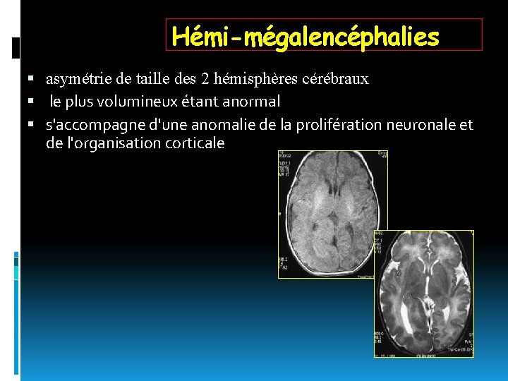 Hémi-mégalencéphalies asymétrie de taille des 2 hémisphères cérébraux le plus volumineux étant anormal s'accompagne