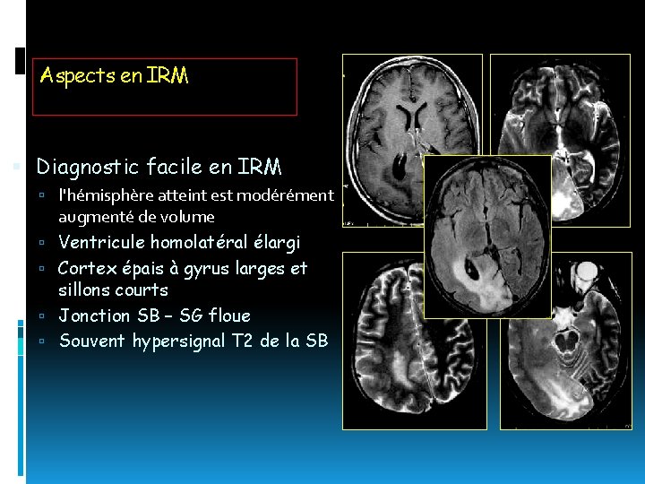 Aspects en IRM Diagnostic facile en IRM l'hémisphère atteint est modérément augmenté de volume