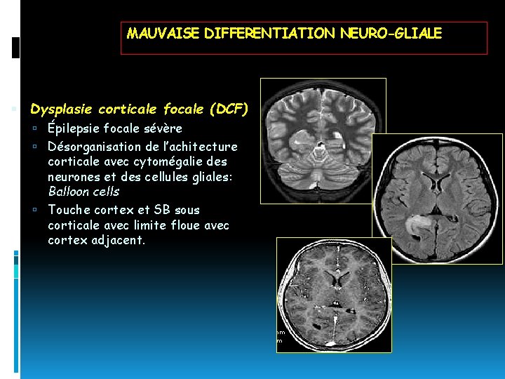 MAUVAISE DIFFERENTIATION NEURO-GLIALE Dysplasie corticale focale (DCF) Épilepsie focale sévère Désorganisation de l’achitecture corticale