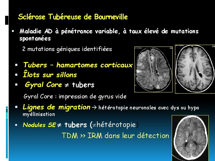 Sclérose Tubéreuse de Bourneville Maladie AD à pénétrance variable, à taux élevé de mutations
