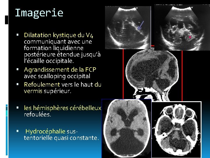 Imagerie Dilatation kystique du V 4 communiquant avec une formation liquidienne postérieure étendue jusqu’à