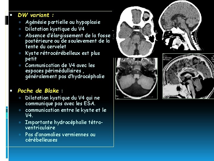  DW variant : Agénésie partielle ou hypoplasie Dilatation kystique du V 4 Absence