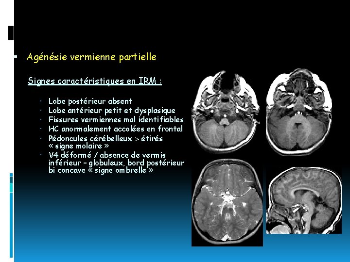  Agénésie vermienne partielle Signes caractéristiques en IRM : Lobe postérieur absent Lobe antérieur