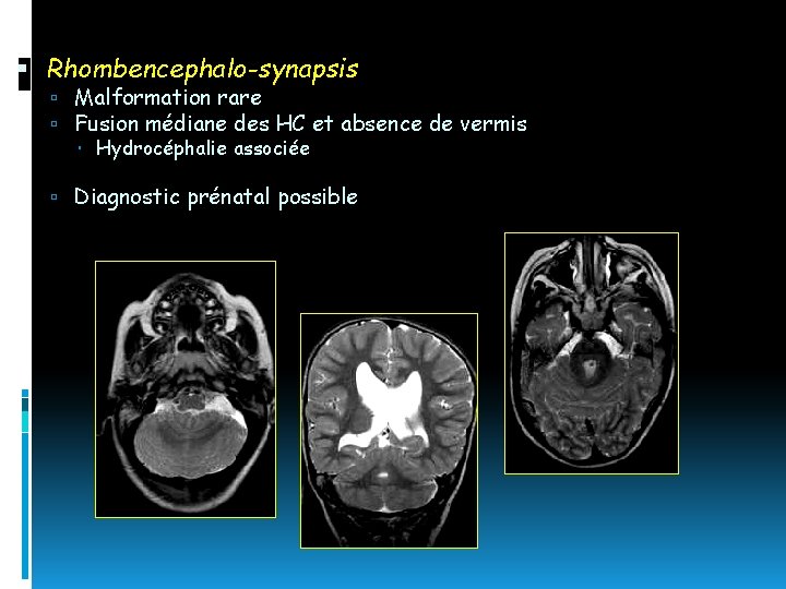  Rhombencephalo-synapsis Malformation rare Fusion médiane des HC et absence de vermis Hydrocéphalie associée