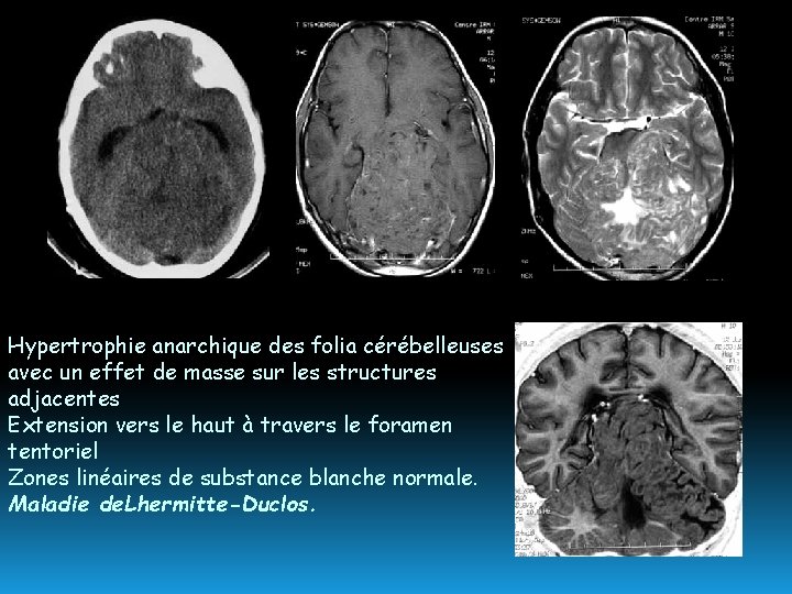 Hypertrophie anarchique des folia cérébelleuses avec un effet de masse sur les structures adjacentes
