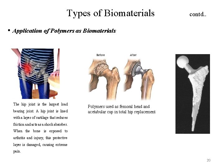 Types of Biomaterials contd. . • Application of Polymers as Biomaterials The hip joint