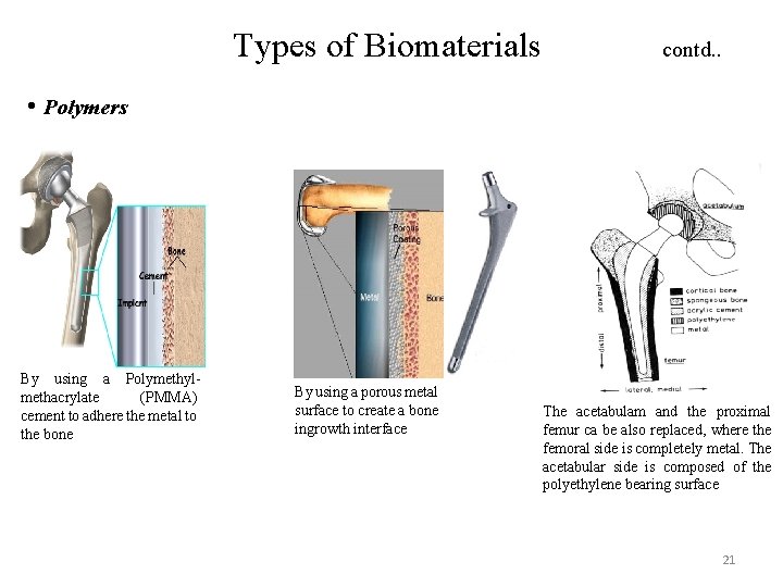 Types of Biomaterials contd. . • Polymers By using a Polymethylmethacrylate (PMMA) cement to